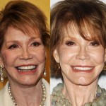 Mary Tyler Moore Before And After Plastic Surgery – An Artist Running For Eternal Beauty